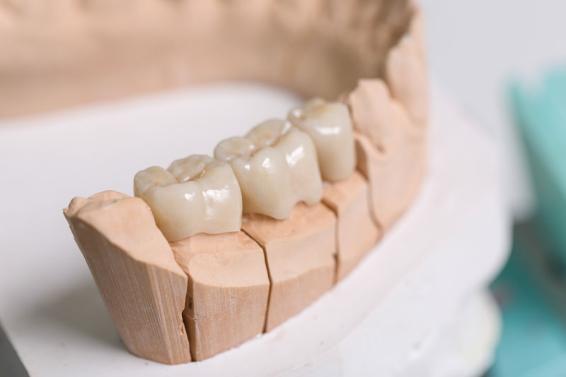 dental bridge model