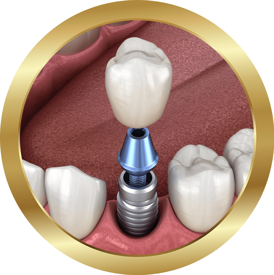 dental implants model