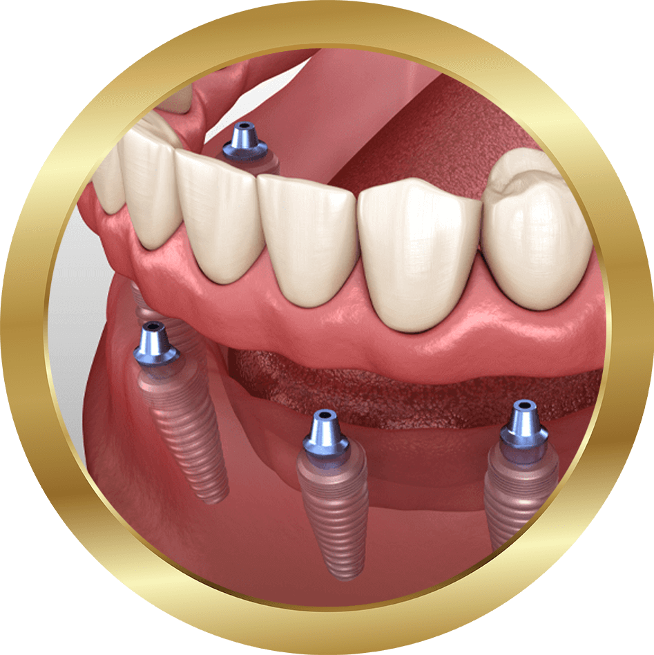 implant supported dentures