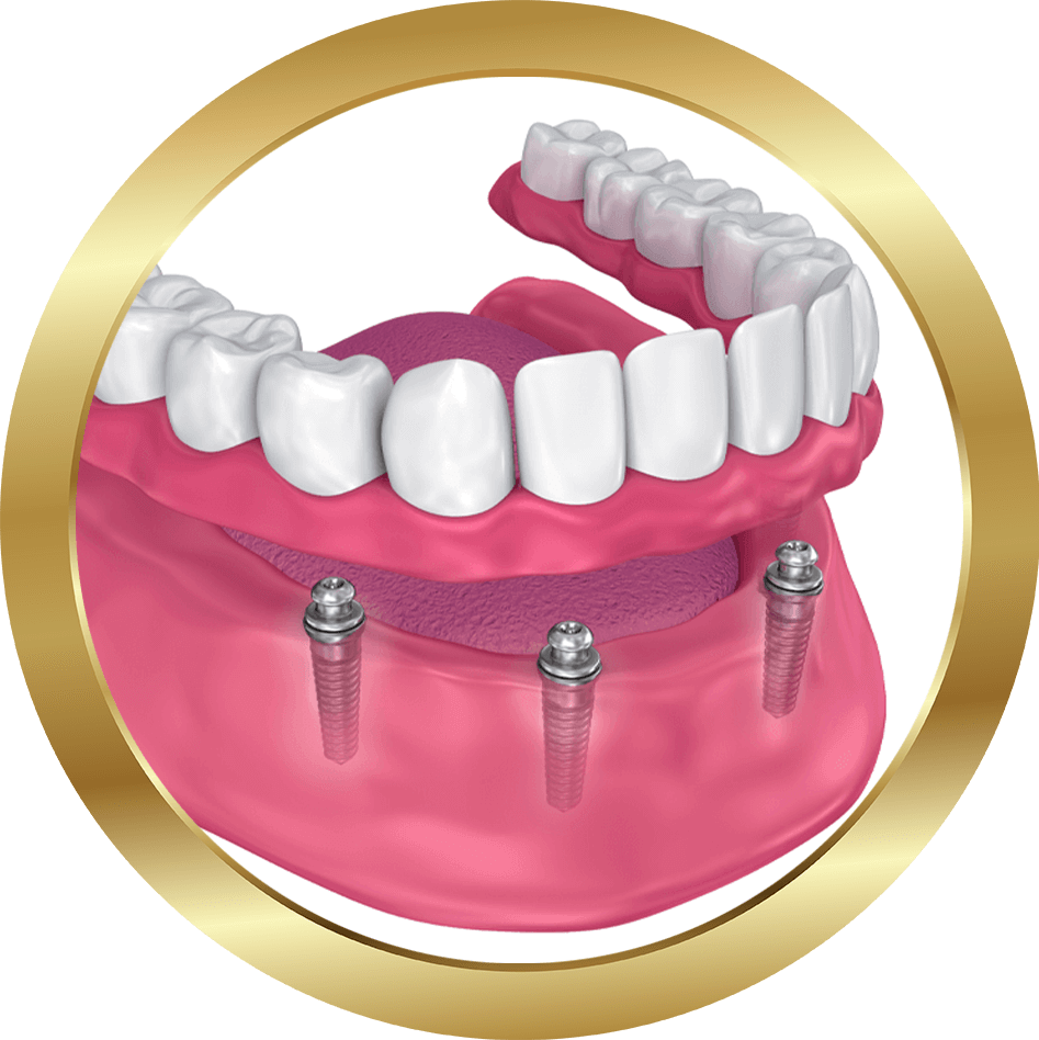 implant supported dentures